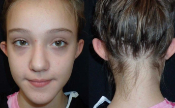 “친구들의 놀림을 견디기 힘들어 성형수술 했어요”